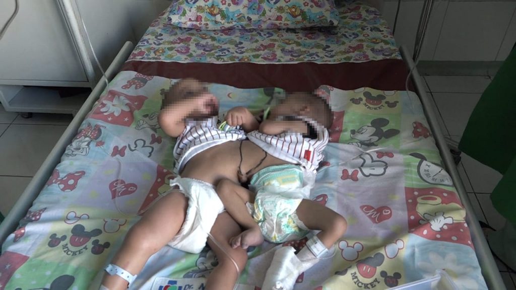 RSUD Dr. Moewardi Berhasil Melakukan Operasi Pemisahan Bayi Kembar Siam “Ba” dan “Br”