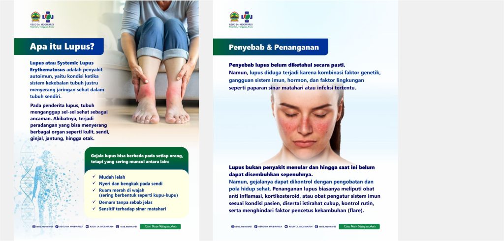 Tahukah Kamu? Apa itu Lupus