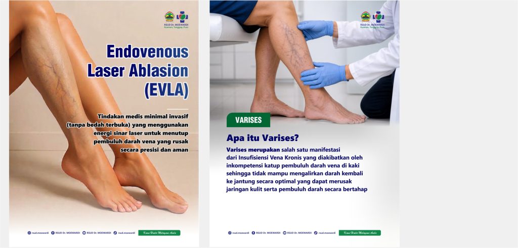Endovenous Laser Ablasion (EVLA)